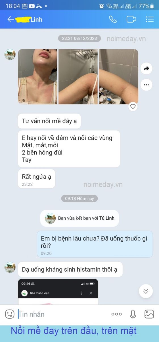 Nổi mề đay trên đầu